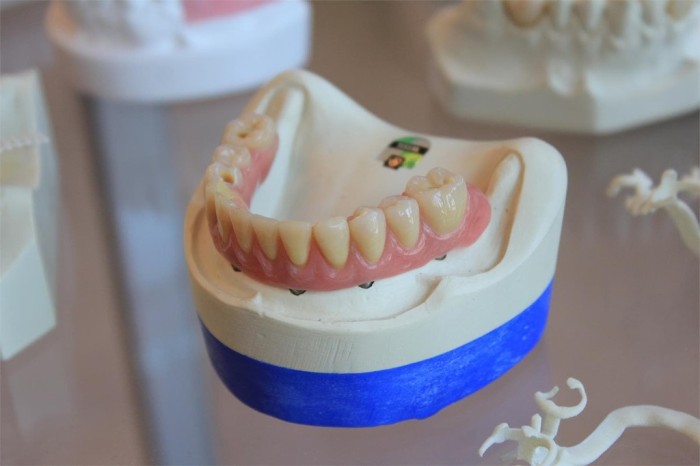 Características del tratamiento de implantes dentales en las clínicas Dental Área
