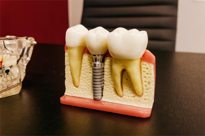 Ventajas de colocarse implantes dentales